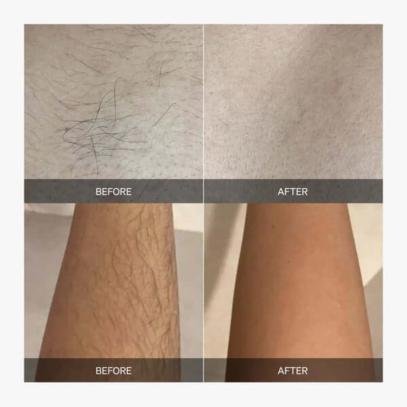 Precision Laser Hair Removal System