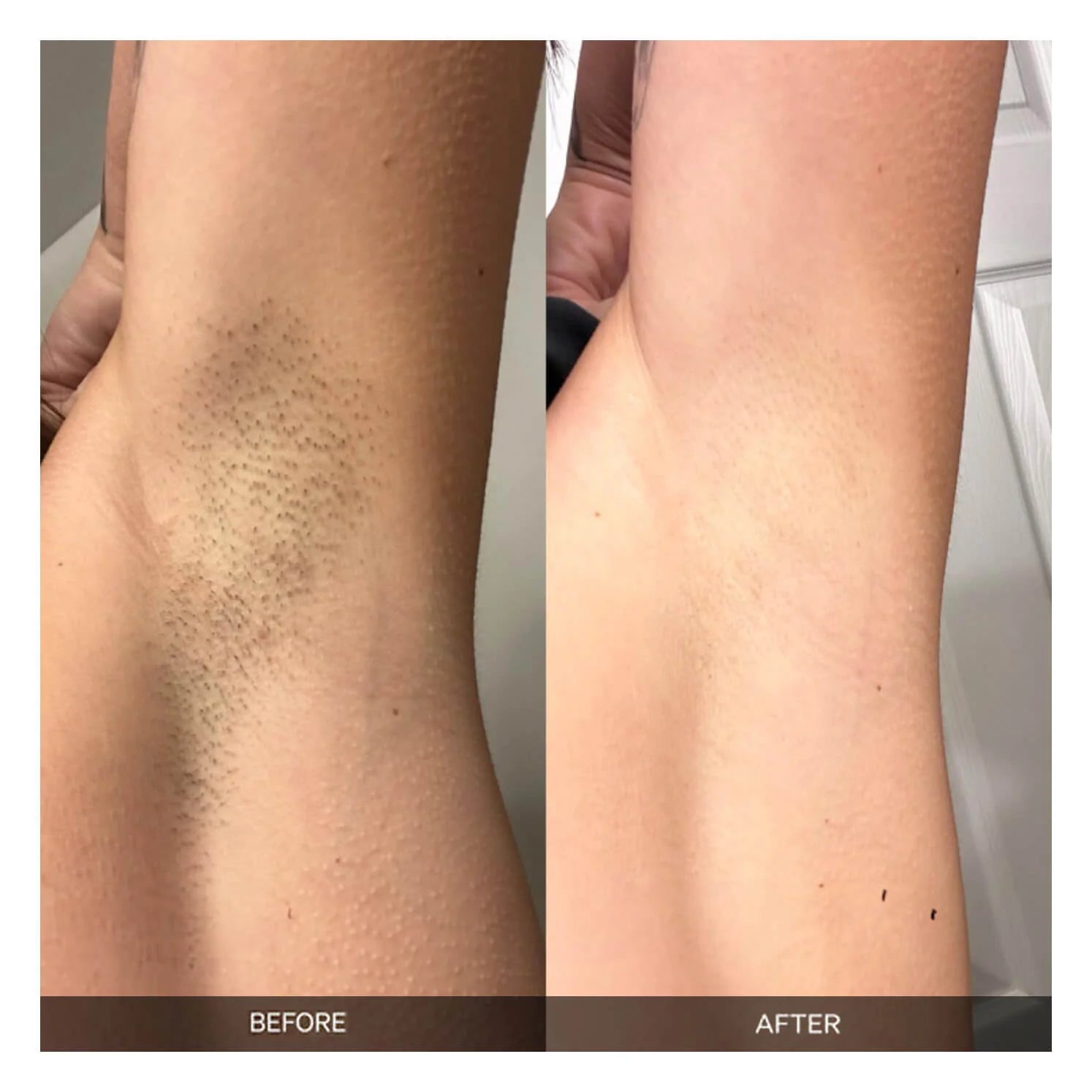Precision Laser Hair Removal System